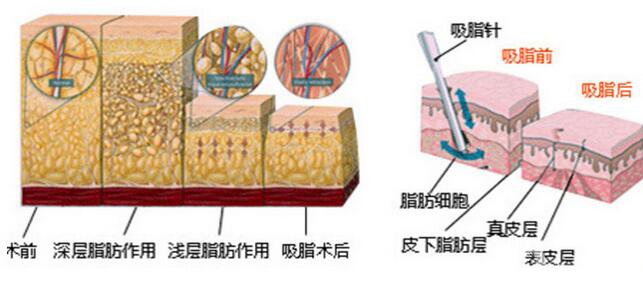 抽脂多少錢 做抽脂手術(shù)貴不貴？