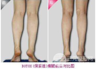 打注射瘦腿要多少錢?注射注射瘦腿價(jià)格?