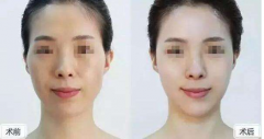 成都自體脂肪填充多少錢？