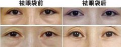 廣東內(nèi)切祛眼袋價(jià)格是多少