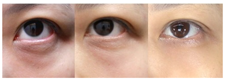 深圳去除黑眼圈手術價格是多少