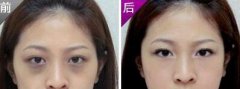 深圳激光去黑眼圈需要多少錢