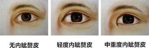 上海眼部整形失敗修復(fù)價格