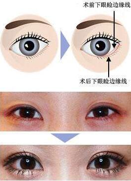 上海下眼下至術(shù)價格