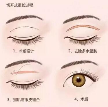北京上眼瞼去脂多少錢(qián)