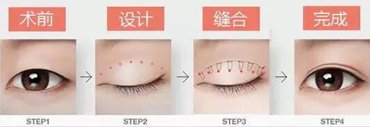 焊接雙眼皮是什么？有哪些特點(diǎn)？