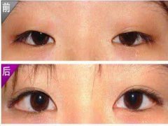 做開眼角的費用