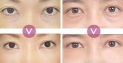 超聲波去眼袋價格、果能保持多久