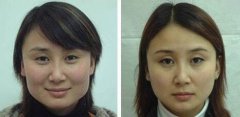 顴骨顴弓整形有風(fēng)險嗎？顴骨顴弓整形注意事項?