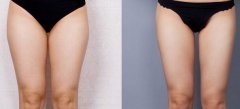 大腿吸脂2000能瘦多少？大概幾厘米？