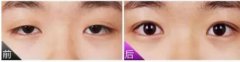 上瞼提肌手術(shù)有必要嗎？不做有什么危害？