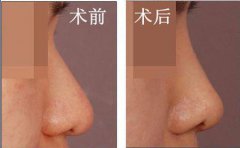 自體軟骨隆鼻是*的嗎？有哪些優(yōu)勢(shì)？