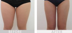 大腿吸脂3500能瘦多少？多久開始瘦？
