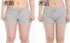 大腿吸脂有幾個切口？大腿環(huán)吸幾個切口？