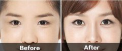 開眼角有風(fēng)險么？怎么預(yù)防？