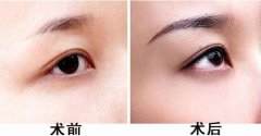 種植眉毛的適合人群有哪些？眉毛種植果圖？