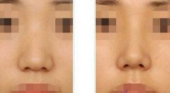 做了隆鼻手術(shù)后的護(hù)理，具體注意事項(xiàng)
