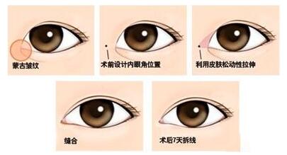 開眼角手術(shù)風(fēng)險(xiǎn)大嗎
