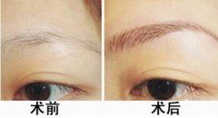 種植眉毛是怎么回事？種植眉毛有什么作用？