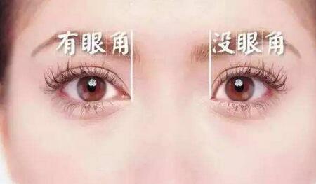 開(kāi)眼角恢復(fù)時(shí)間要多久？多久恢復(fù)自然？