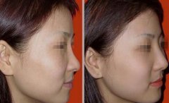 隆鼻以后怎么恢復快，術后如何護理?
