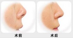 北京自體墊鼻子要花多少錢？自體墊鼻子費(fèi)用大概是多少？
