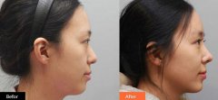 隆鼻多久消腫自然，術后多久能恢復？