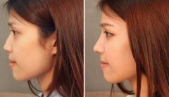 北京膨體隆鼻價(jià)格是多少？膨體隆鼻手術(shù)多少錢？