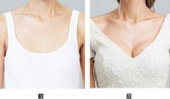 假體豐胸能保持多久，假體豐胸果可以維持多久？