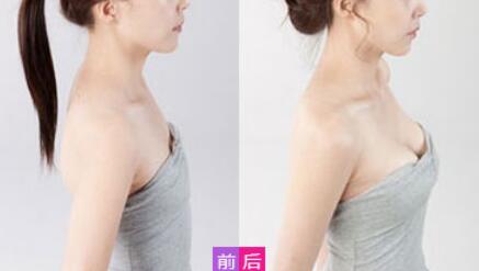 威寧假體豐胸怎么樣？威寧假體豐胸*果如何？
