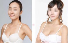 上海假體豐胸手術(shù)多少錢？上海假體豐胸價(jià)格？