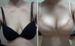 上海假體豐胸費(fèi)用、上海假體豐胸手術(shù)多少錢？