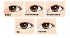 韓式開眼角手術(shù)果怎么樣？開眼角前后照