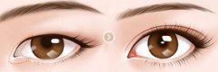 做開(kāi)眼角大概多少錢(qián)？做開(kāi)眼角的價(jià)格