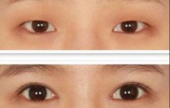 做開(kāi)眼角價(jià)格、開(kāi)眼角費(fèi)用詳細(xì)解析