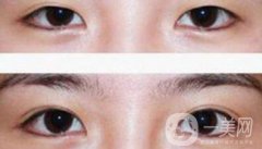 割雙眼皮多少錢(qián)？雙眼皮手術(shù)費(fèi)用詳細(xì)解答
