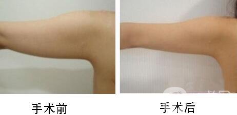 手臂吸脂術(shù)*嗎？手臂吸脂有危險(xiǎn)嗎？
