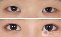 開(kāi)眼角需要多少錢(qián)？開(kāi)眼角和不開(kāi)的區(qū)別圖