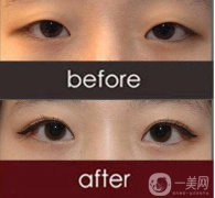 改臉型手術(shù)多少錢？改臉型手術(shù)有危險(xiǎn)嗎？