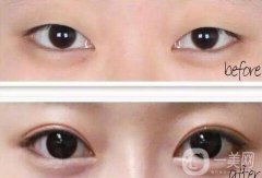 雙眼皮開(kāi)眼角價(jià)格是多少？割雙眼皮開(kāi)眼角多少錢？