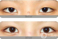 開眼角割雙眼皮價(jià)格、開眼角割雙眼皮多少錢？