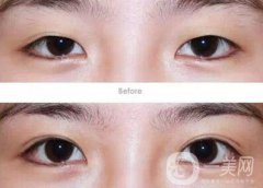 成都割雙眼皮哪里專業(yè)？割雙眼皮介紹？