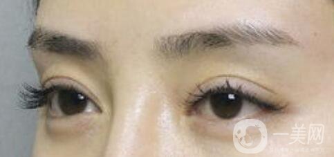 上海自體脂肪豐眉弓價(jià)格、自體脂肪豐眉弓多少錢