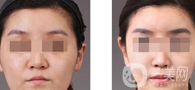 上海自體脂肪豐眉弓價(jià)格、自體脂肪豐眉弓多少錢