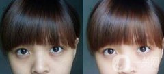 黑眼圈可以打玻尿酸嗎？玻尿酸去黑眼圈果如何？