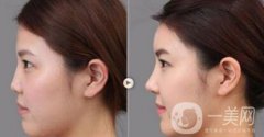 上海假體隆鼻多少費(fèi)用？假體隆鼻價(jià)格詳細(xì)分析