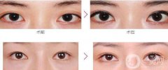 杭州割雙眼皮價(jià)格貴不貴？?jī)r(jià)格是多少？