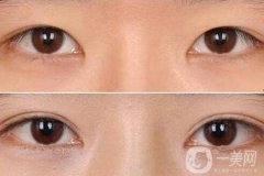 割雙眼皮后注意什么？術(shù)后注意事項(xiàng)盤點(diǎn)~