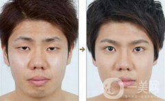 男士割雙眼皮果怎樣？有哪些方式？