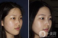 廣東硅膠隆鼻需要多少錢呢？廣東硅膠隆鼻價格？